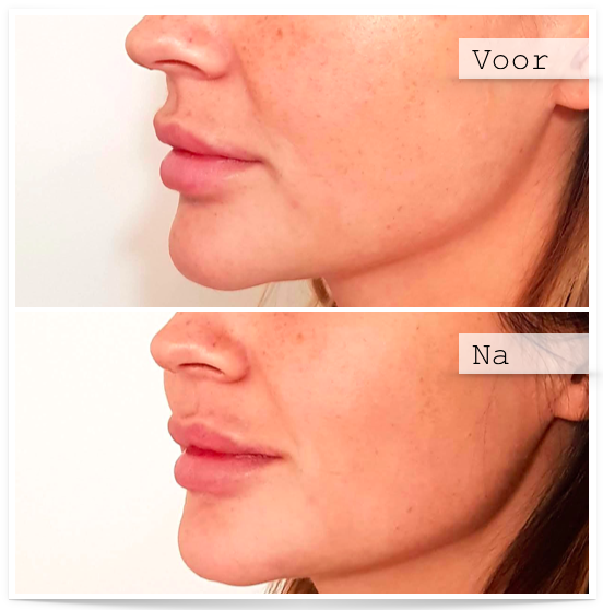 Botox Behandelingen Nederland