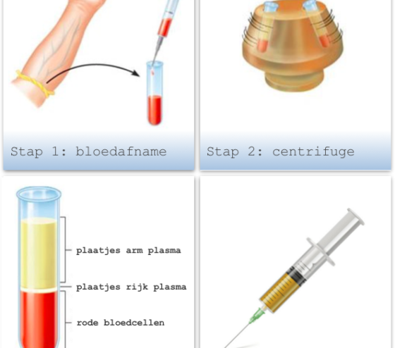 Botox Behandelingen Nederland