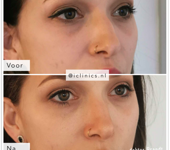 Botox Behandelingen Nederland
