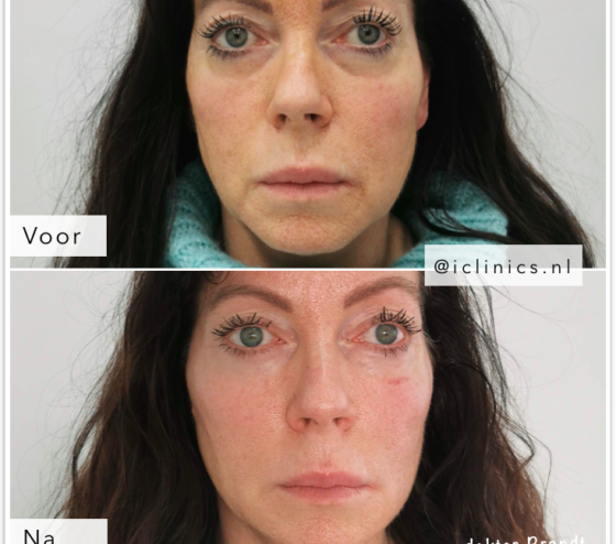 Botox Behandelingen Nederland