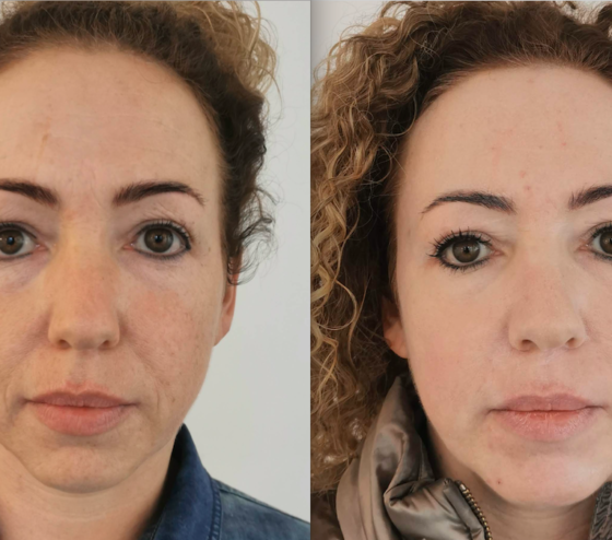 Botox Treatments Netherlands