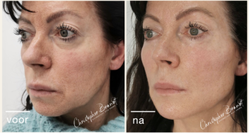 natuurlijk resultaat fillers dokter Brandt amsterdam