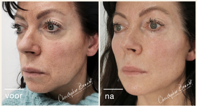 natuurlijk resultaat fillers dokter Brandt amsterdam