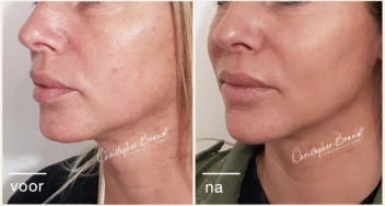 liquid facelift endolifting amsterdam dokter brandt