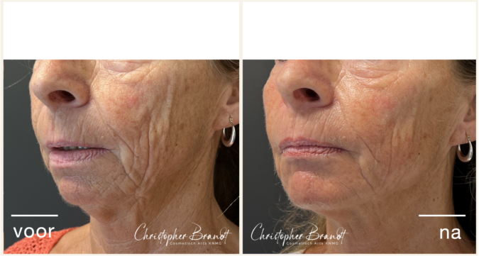 liquid facelift dokter brandt