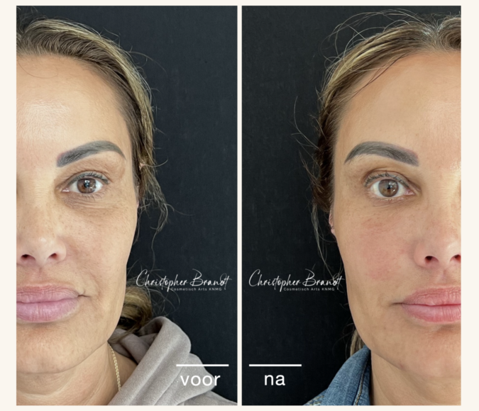 Liquid facelift dokter Brandt Amsterdam