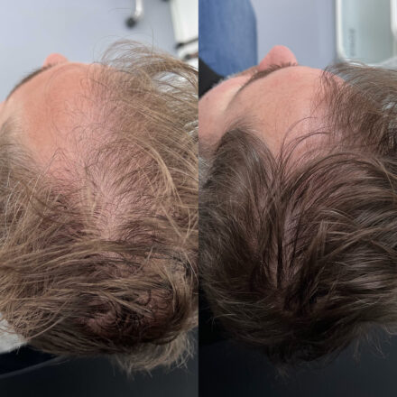 stamcel behandeling voor haargroei