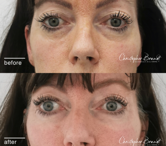 liquid facelift bij Kliniek Dokter Brandt. 