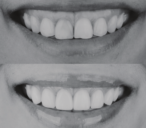 Botox Behandelingen Amsterdam