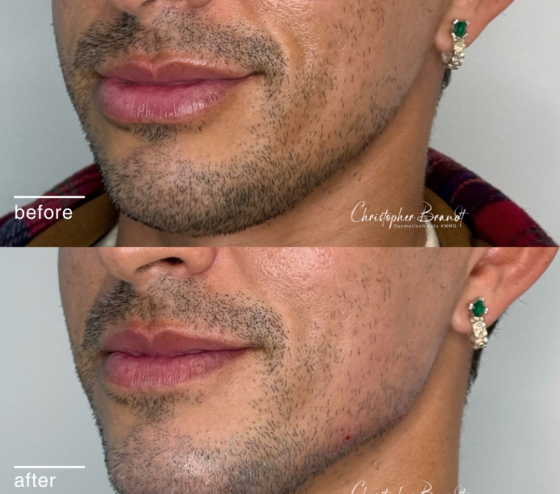 Fillers Amsterdam