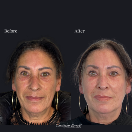 Voor en na stemcellen, lipofilling, radiesse