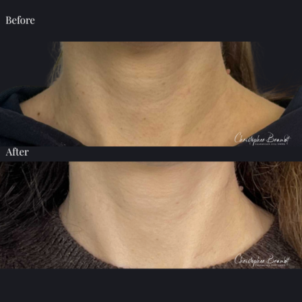 Before and after image of stem cell treatment