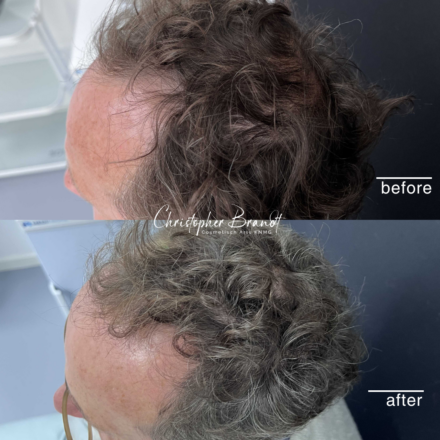 Seffi Hair Treatment with stem cells at Kliniek Dokter Brandt for stronger and healthier hair