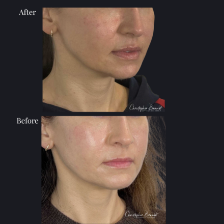 Before and after regenerative facial treatment using stem cells, Seffiller, lipofilling, micro- and nanofat combined with Morpheus8 microneedling and radiofrequency in Amsterdam