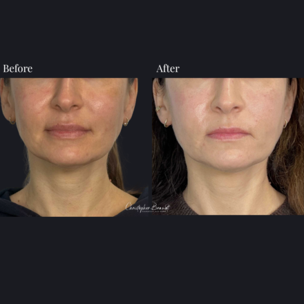 Before and after regenerative facial treatment using stem cells, Seffiller, lipofilling, micro- and nanofat combined with Morpheus8 microneedling and radiofrequency in Amsterdam