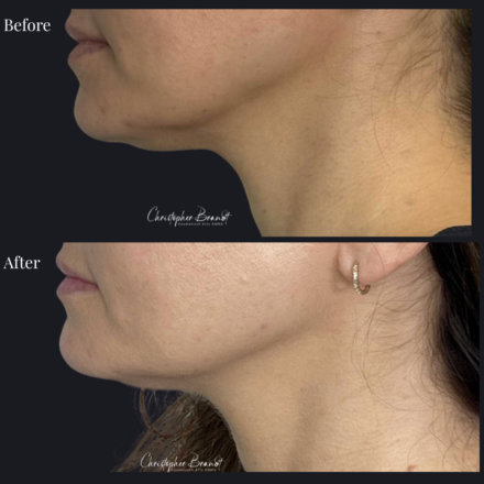 Before and after regenerative facial treatment using stem cells, Seffiller, lipofilling, micro- and nanofat combined with Morpheus8 microneedling and radiofrequency in Amsterdam