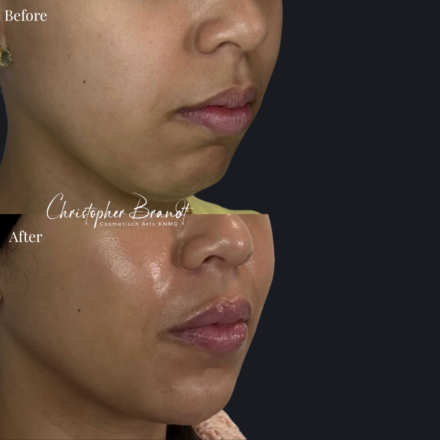 Before and after regenerative facial treatment using chin and lip fillers for natural volume restoration and contour improvement in Amsterdam