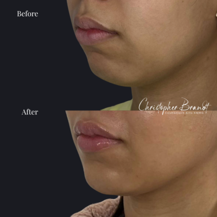 Before and after regenerative facial treatment using chin and lip fillers for natural volume restoration and contour improvement in Amsterdam