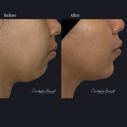 Before and after regenerative facial treatment using chin and lip fillers for natural volume restoration and contour improvement in Amsterdam