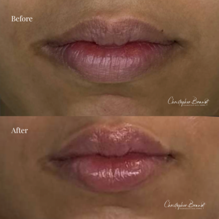 Before and after regenerative facial treatment using chin and lip fillers for natural volume restoration and contour improvement in Amsterdam