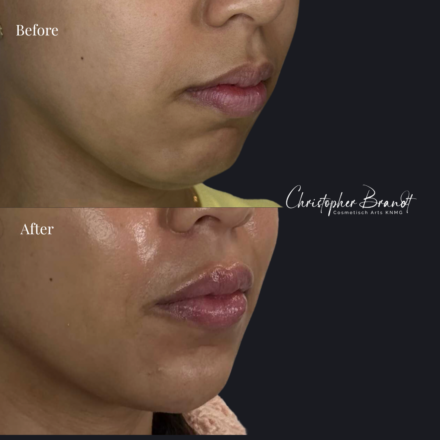 Before and after regenerative facial treatment using chin and lip fillers for natural volume restoration and contour improvement in Amsterdam
