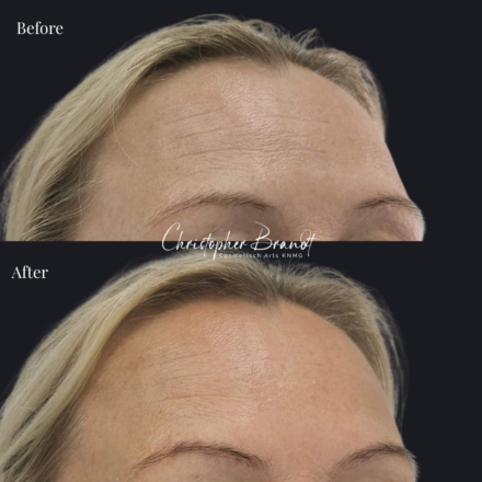 Before and after regenerative facial treatment using Botox for forehead wrinkles, performed by Dr. Christopher Brandt at Kliniek Dokter Brandt in Amsterdam for natural wrinkle reduction and facial rejuvenation