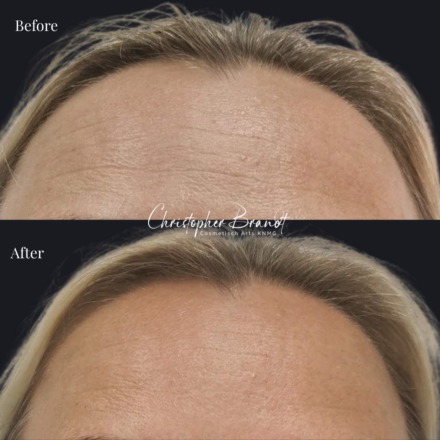 Before and after regenerative facial treatment using Botox for forehead wrinkles, performed by Dr. Christopher Brandt at Kliniek Dokter Brandt in Amsterdam for natural wrinkle reduction and facial rejuvenation