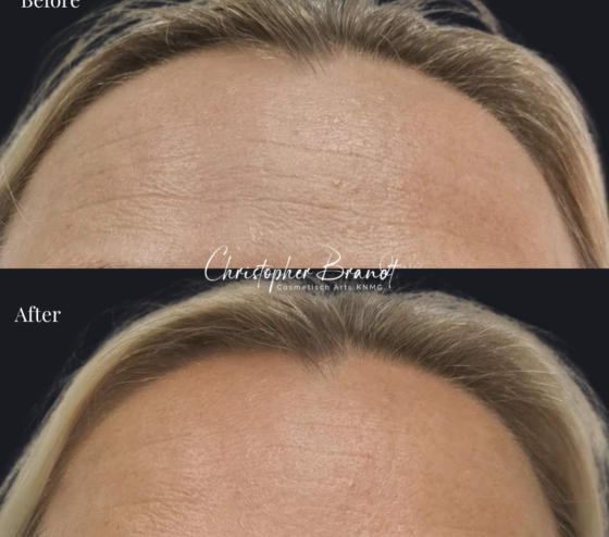 Botox Treatments Amsterdam kliniek Dokter Brandt 