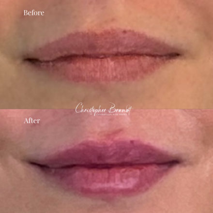 Before and after regenerative facial treatment using lip fillers, performed by Dr. Christopher Brandt at Kliniek Dokter Brandt in Amsterdam for natural volume restoration and contour enhancement