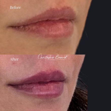 Before and after regenerative facial treatment using lip fillers, performed by Dr. Christopher Brandt at Kliniek Dokter Brandt in Amsterdam for natural volume restoration and contour enhancement