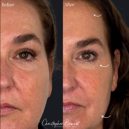 Before and after regenerative facial treatment using Morpheus8 microneedling and radiofrequency, performed by Dr. Christopher Brandt at Kliniek Dokter Brandt in Amsterdam