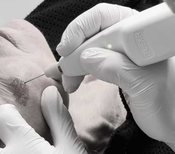 Plexr behandeling bij Kliniek Dokter Brandt in Amsterdam