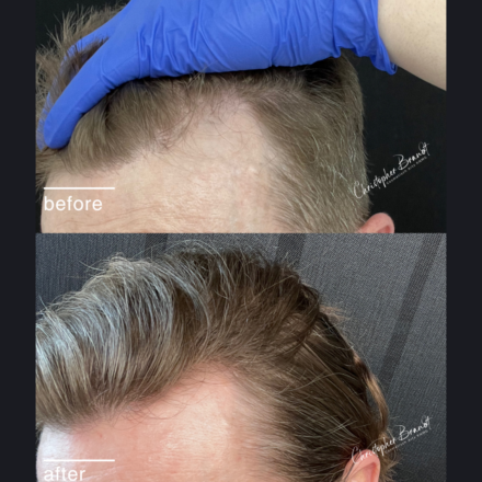 Seffi Hair Treatment with stem cells at Kliniek Dokter Brandt for stronger and healthier hair