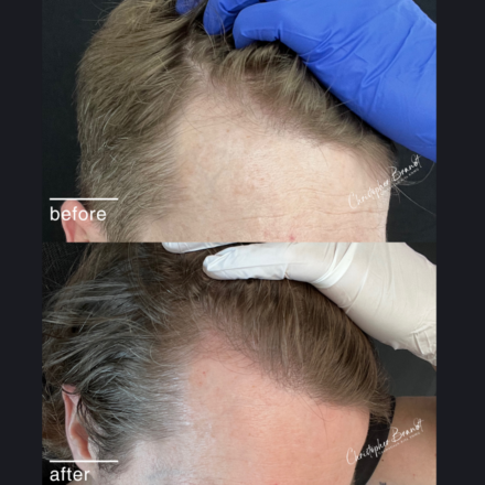 Seffi Hair Treatment with stem cells at Kliniek Dokter Brandt for stronger and healthier hair