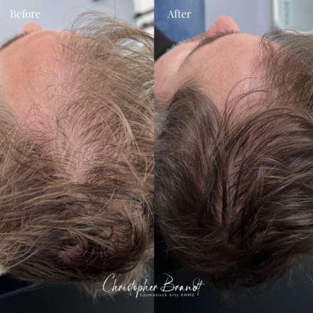 Seffi Hair Treatment met Stamcellen