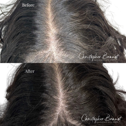 Seffi Hair Treatment with stem cells at Kliniek Dokter Brandt for stronger and healthier hair
