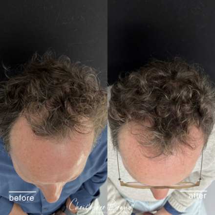 Seffi Hair Treatment with stem cells at Kliniek Dokter Brandt for stronger and healthier hair