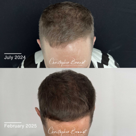 Seffi Hair Treatment with stem cells at Kliniek Dokter Brandt for stronger and healthier hair