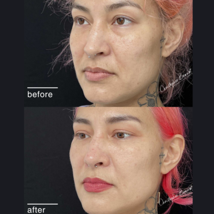 Before and after regenerative facial treatment using stem cells, Seffiller, lipofilling, micro- and nanofat in Amsterdam