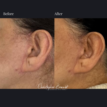 Before and after regenerative facial treatment using stem cells for natural volume restoration and skin rejuvenation in Amsterdam