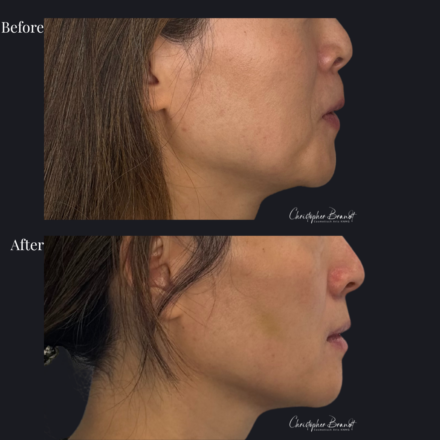 Before and after regenerative facial treatment using stem cells for natural volume restoration and skin rejuvenation in Amsterdam