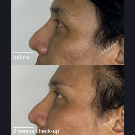 Before and after regenerative facial treatment using stem cells, Seffiller, lipofilling, micro- and nanofat in Amsterdam