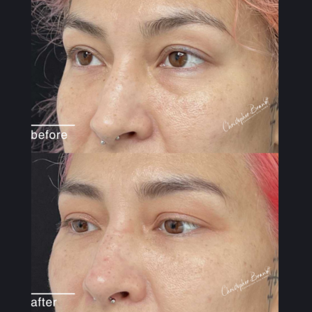 Before and after regenerative facial treatment using stem cells, Seffiller, lipofilling, micro- and nanofat in Amsterdam