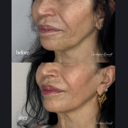 Before and after regenerative facial treatment using stem cells, Seffiller, lipofilling, micro- and nanofat combined with Morpheus8 microneedling and radiofrequency in Amsterdam