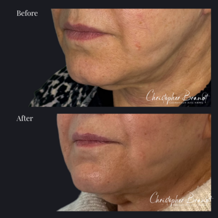 Before and after regenerative facial treatment using stem cells for natural volume restoration and skin rejuvenation in Amsterdam