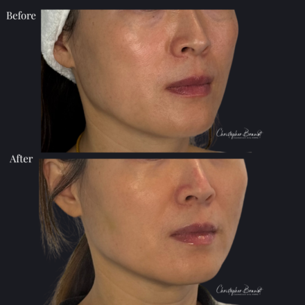 Before and after regenerative facial treatment using stem cells for natural volume restoration and skin rejuvenation in Amsterdam