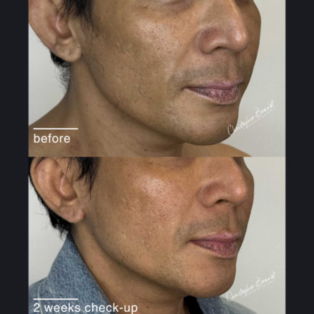 Before and after regenerative facial treatment using stem cells, Seffiller, lipofilling, micro- and nanofat in Amsterdam