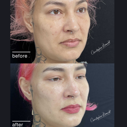 Before and after regenerative facial treatment using stem cells, Seffiller, lipofilling, micro- and nanofat in Amsterdam