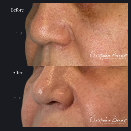Before and after regenerative facial treatment using stem cells for natural volume restoration and skin rejuvenation in Amsterdam