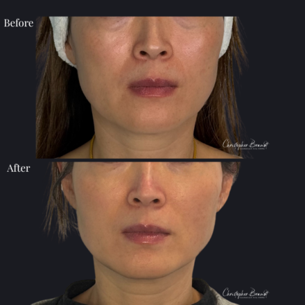 Before and after regenerative facial treatment using stem cells for natural volume restoration and skin rejuvenation in Amsterdam